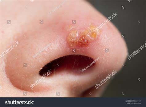 Closeup Nose Herpes Simplex Infection Blisters Stock Photo 1786592141