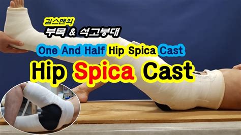 Hip Spica Cast Youtube