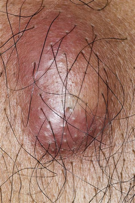 Sebaceous Cyst Stock Image C0135834 Science Photo