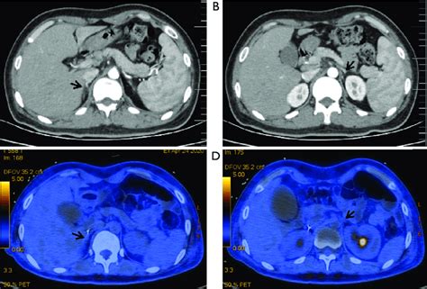 Ct Findings Of The Bilateral Adrenal Glands A And B Enhanced Ct Image