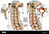 Puesto condición de accidente con espondilosis Osteophytes y la ...