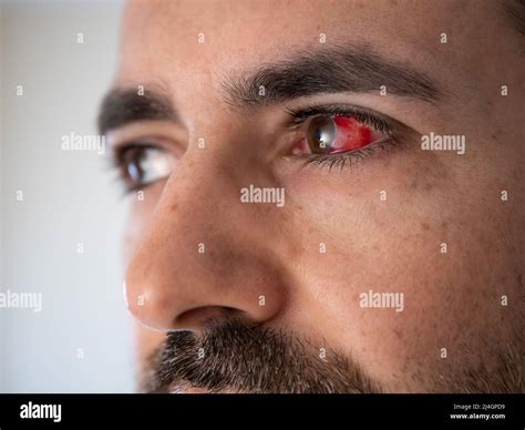 Subconjunctival Hemorrhage On Man Eye Bloody Eye Broken Blood Vessel