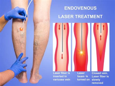 Varicose Vein Surgery Drbeckmann