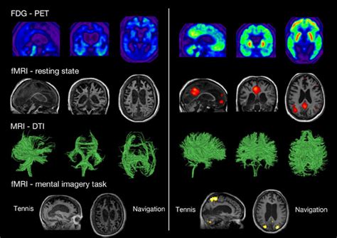 The Role Of Neuroimaging Techniques In Establishing Diagnosis