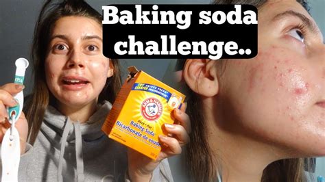 Acne Is Caused By Low Stomach Acid Baking Soda Challenge Test For