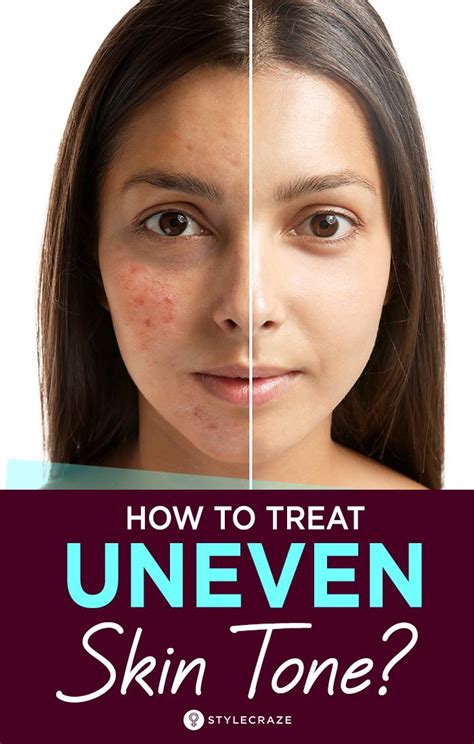 Uneven Skin Tone On Face Best Creams For Uneven Skin Tone In India