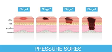 Pressure Ulcer Grades Pressure Ulcer Soreness Ulcers