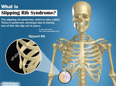 Slipping Rib Syndrome Causes Symptoms Treatment Recovery Period Hot