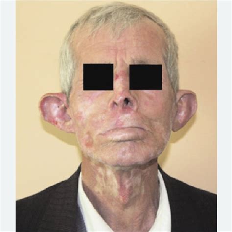 Preoperative Anterior View Of The Patient With Discoid Lupus