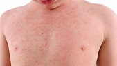 How to get rid of heat rash and prickly heat in children and adults ...