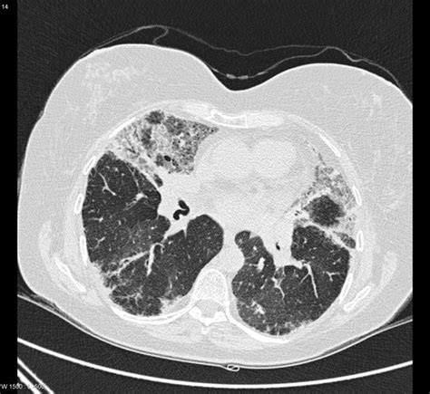 Eosinophilic Lung Disease Chronic Radiology Case