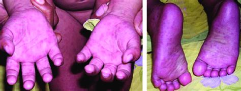 Typical Lesions Of Papular Purpuric Gloves And Socks Syndrome In An