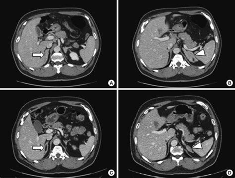 Adrenal Gland Hyperplasia