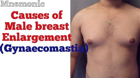 Causes Of Male Breast Enlargement Gynaecomastia Mnemonic Youtube