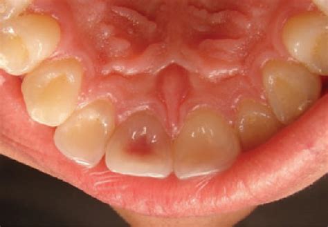 Figure 1 From Double Pink Tooth Associated With Extensive Internal