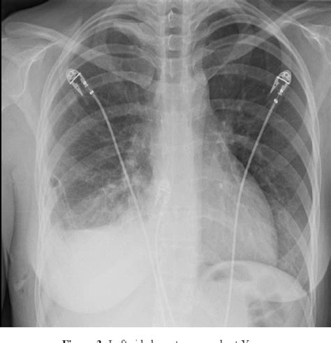 Figure From A Recurrent And Non Resolving Primary Spontaneous
