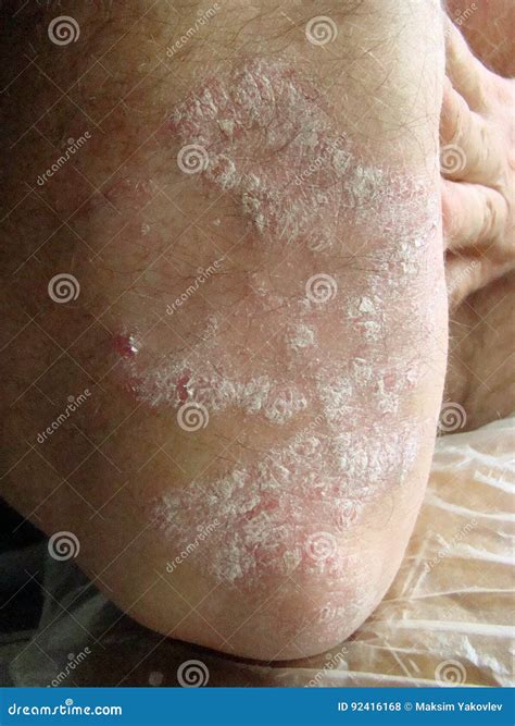 Psoriasis Stock Photo Image Of Rash Itching Skin Pustular 92416168