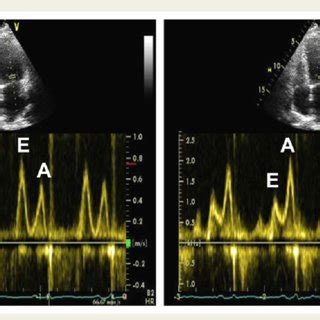 Patient With Mitral Stenosis And Lv Diastolic Dysfunction A Color
