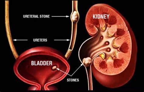 Kidney Stone Urology Specialist In Dubai Kidney Problem