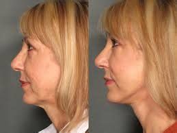 Best hair length if i have jowels. Best Facial Jowl Exercises to Tighten, Remove and Lift Sagging Jowls | Facial exercises, Jowl ...