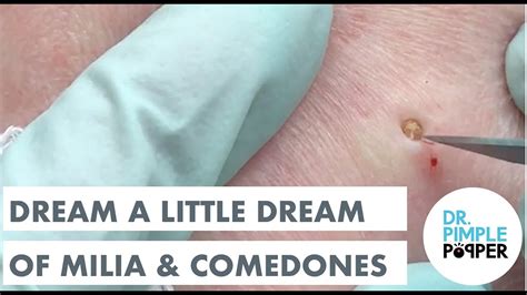 Dream A Little Dream Of Milia And Comedones Medley Youtube