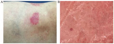 Plaque Psoriasis A Clinical Image Of A Round Well Demarcated
