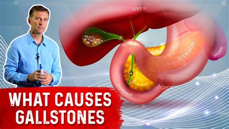 What Really Causes Gallstones Dr Berg Youtube