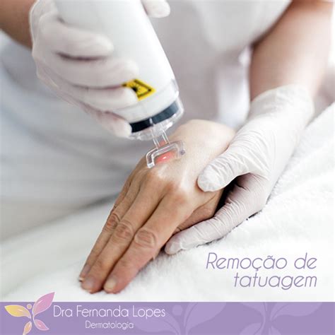 Dra Fernanda Lopes Dermatologia Blog Remoção De Tatuagem