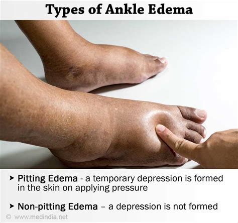 Edema Swollen Feet
