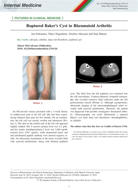 Pdf Ruptured Bakers Cyst In Rheumatoid Arthritis