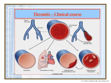 5 Thrombosis Hemodynamic Disorders