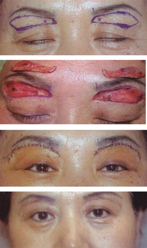 Eyelid Surgery By Prof Dr Cn Chua 蔡鐘能 Doctor Could You Lift My