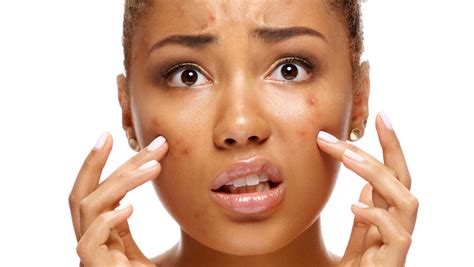 How To Prevent And Treat Post Inflammatory Hyperpigmentation