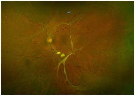 Ultra Widefield Fundus Photograph Of The Left Eye In A Patient With A
