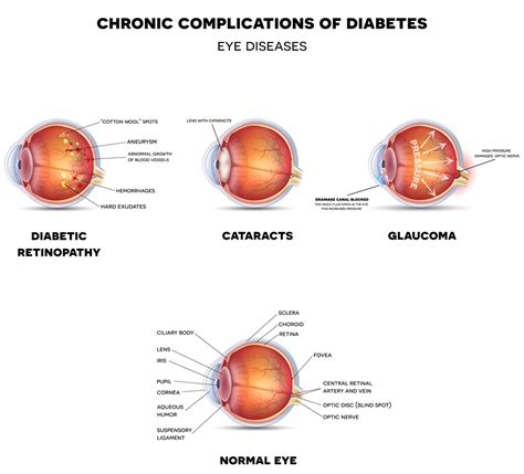 Diabetic Eye Disease Eye Patient
