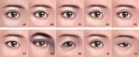 Category Of Upper Eyelid Morphology And The Preferred Double Eyelid