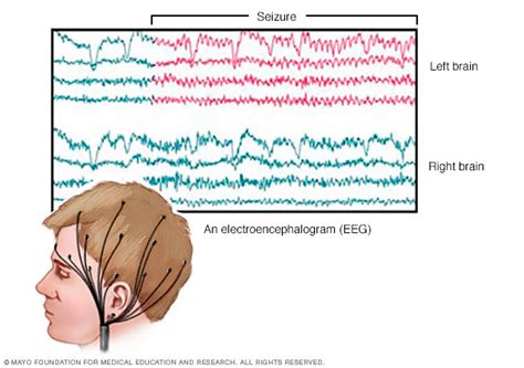Eeg Electroencephalogram Beacon Health System