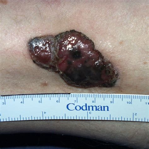 Vorbeugung und früherkennung können die entwicklung des hautkrebses entgegenwirken. Schwarzer Hautkrebs (Melanom) - Praxisklinik Dr. Hasert ...