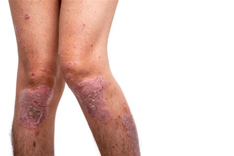 150 Psoriasis Knee Stock Photos Pictures And Royalty Free Images Istock