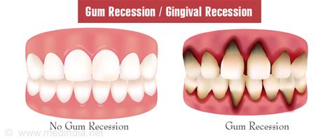 Gum Recession Gingival Recession Causes Symptoms Diagnosis And