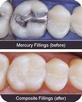 Photos of Is There Mercury In Silver Fillings