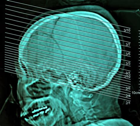 Computerized Film X Ray Tomography Of Human Brain Ct Scan Stock Image