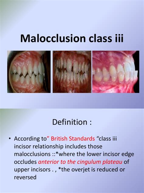 Malocclusion Class Iii Pdf Dental Anatomy Dentistry Branches