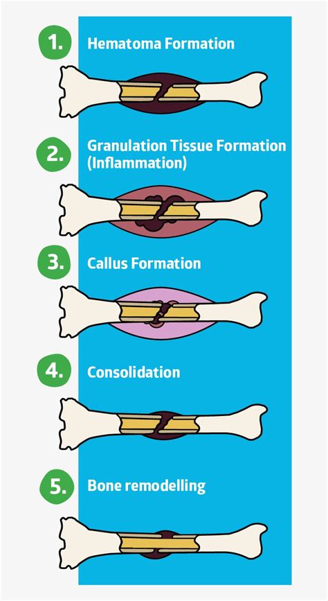 Download Hematoma Formation Fracture Healing Stages Hd Transparent