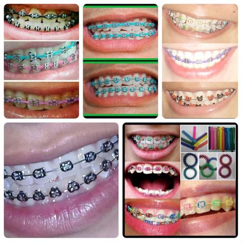 Jual Behel Fashion Lepas Pasang Bracket Asli Di Lapak Orthobehell