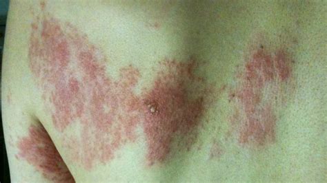 Shingles Rash Under Armpit