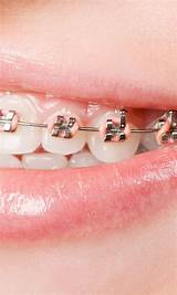 Images of Braces Monthly Payment Plan