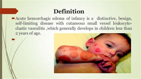 Acute Haemorrhagic Edema Of Infacy