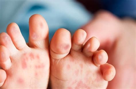 Hand Foot And Mouth Disease Hfmd Causes And Symptoms June 2020