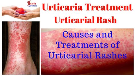 Urticaria Rash Causes